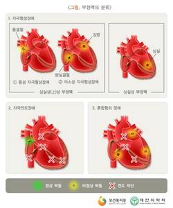 불규칙한 심장박동…발작성 심방세동 90% 완치