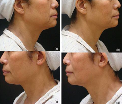 치료 전 임상사진 (a),(c)와 치료 90일 후 임상사진 (b),(d)