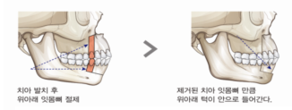 잇몸뼈 돌출에 의한 돌출입 – 돌출입수술