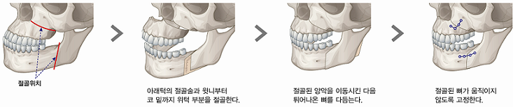 양악수술 원리