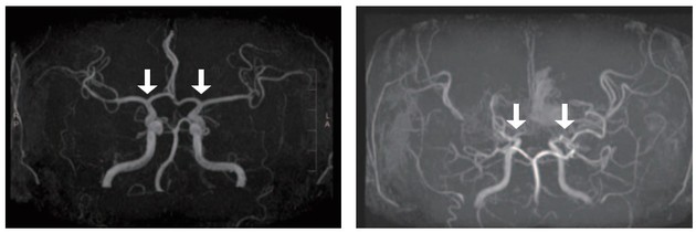 전국 소아 모야모야병 역학 분석, 사망·뇌졸중 발생률 감소 확인