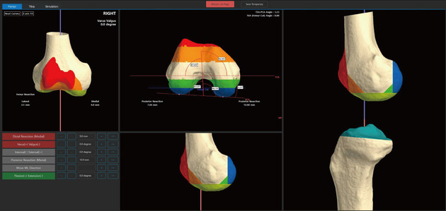 강북연세병원, AI-3D프린팅 기술 결합한 인공관절 수술 본격 시행