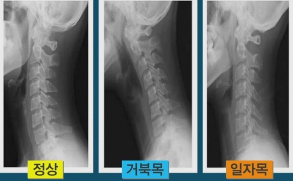 <S134> 경추 염좌와 긴장/목 디스크 악화? 상해보험금 필요!